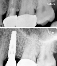 Dental Implant Introduction