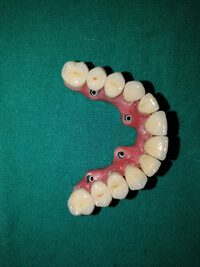 Full Arch Implant