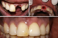 Single Tooth Implant