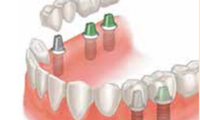 Multiple Tooth Implant