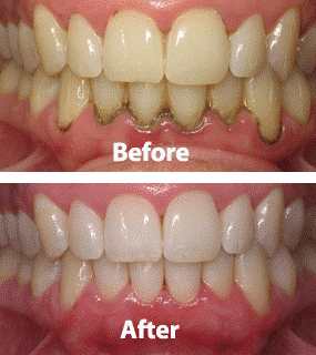 Periodontal Diseases