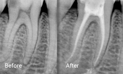 Root Canal Treatment